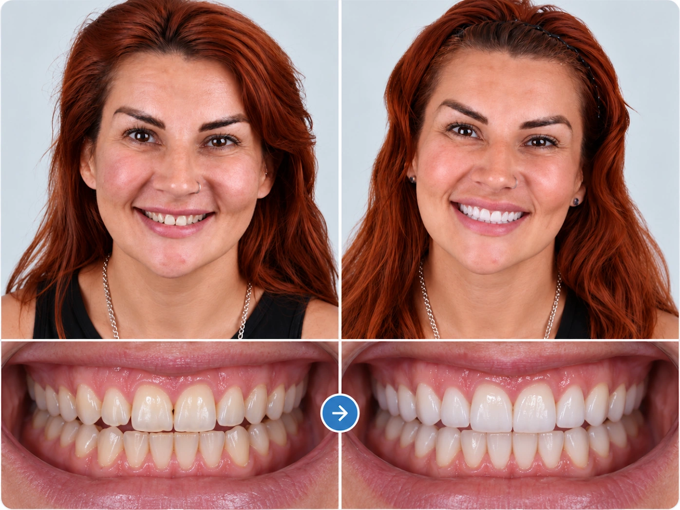 Breana Benevedes — Avora Dental before and after treatment