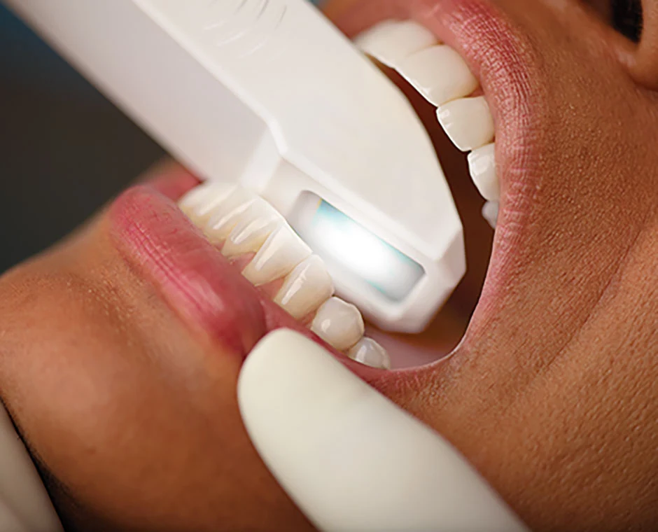 iTero Intraoral Scanner
